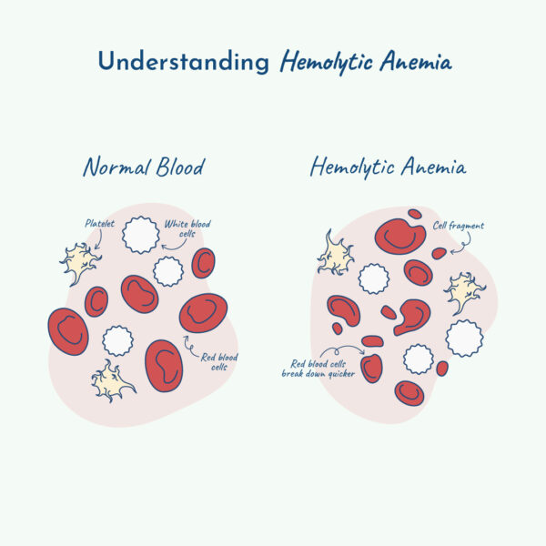 Illustration of how hemolytic anemia works